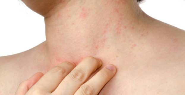 Rashes Visage Dermatology Rashes Visage Dermatology