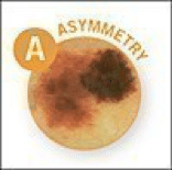 asymmetry melanoma