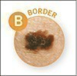 border melanoma