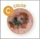 color melanoma