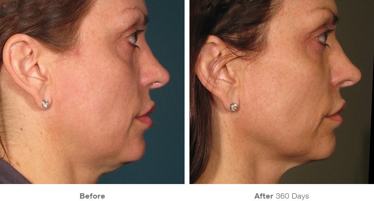 Facial Tightening Ultherapy Results