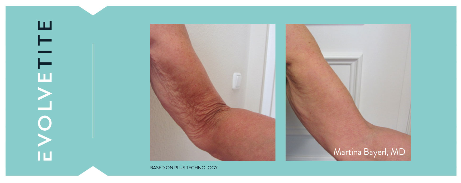 Evolve Tite Before and After - Visage Dermatology