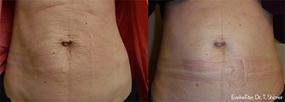 evolve tite before and after results of belly tightening