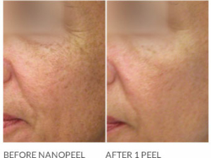 NANO Laser Peel Before and After Image 1